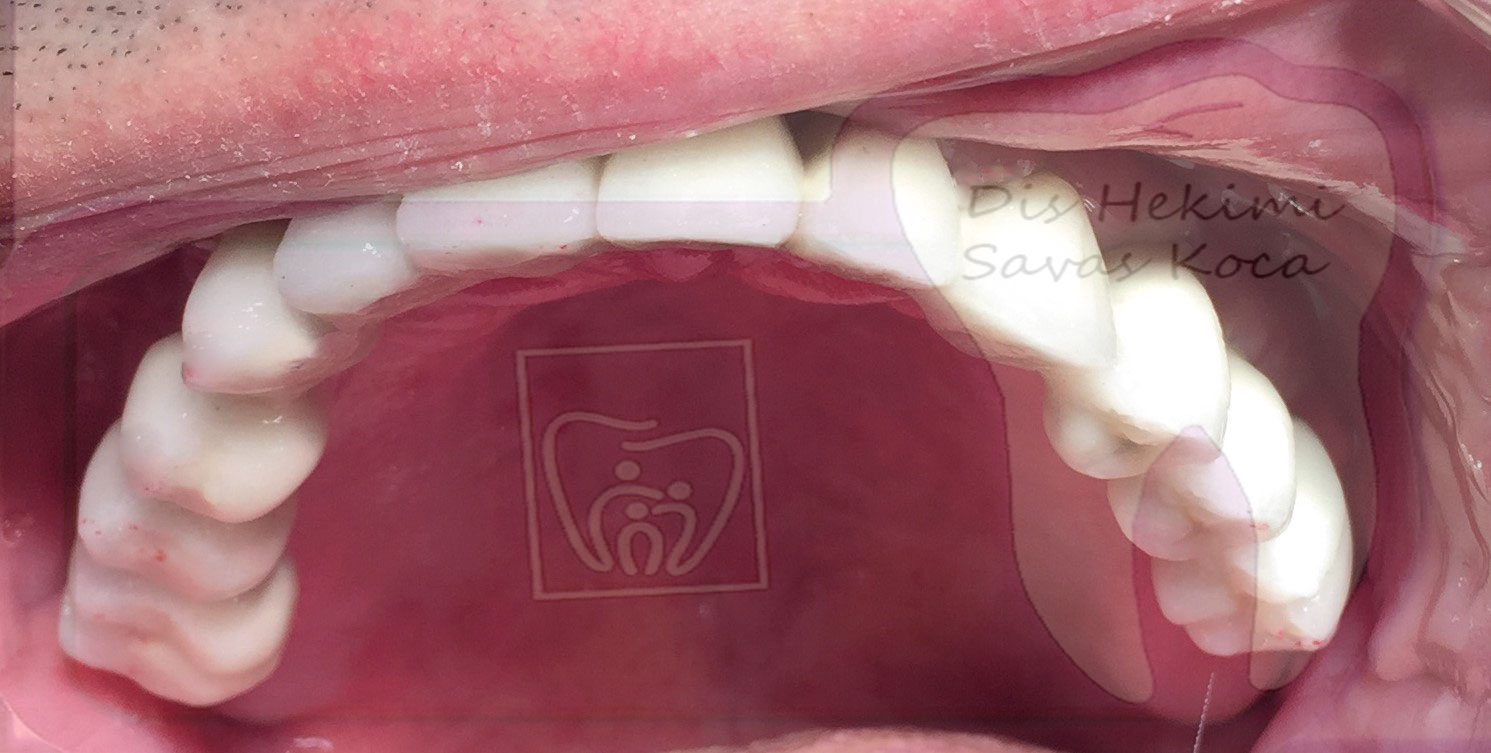 İmplant Simante Sistem Sonrası